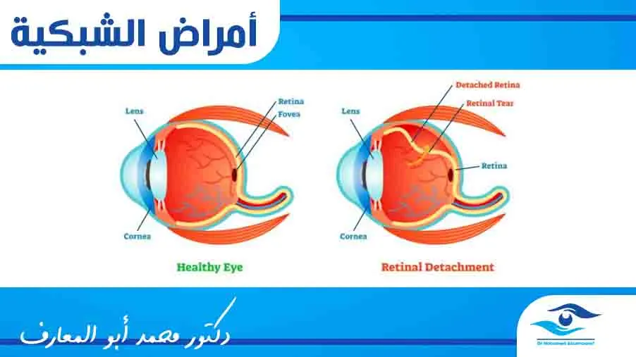 أمراض الشبكية