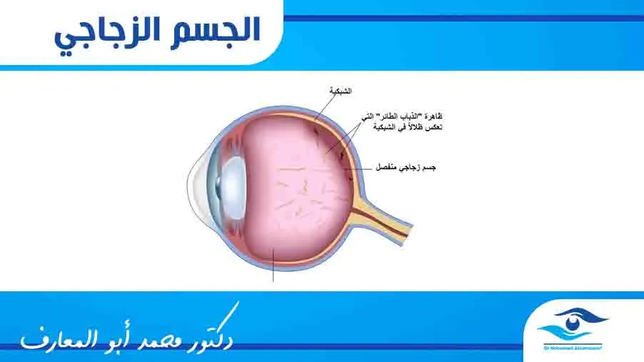 علاج الجسم الزجاجى